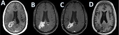 Immunotherapy associated central nervous system complications in primary brain tumors